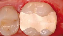 Multi-Purpose-Dentinersatzmaterial auf Basis der aktiven Biosilikat-Technologie