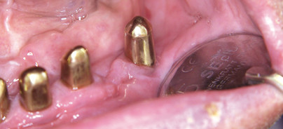 Periimplantäre Entzündungen