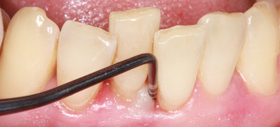 Parodontologische Prävention