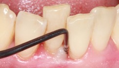 Parodontologische Prävention