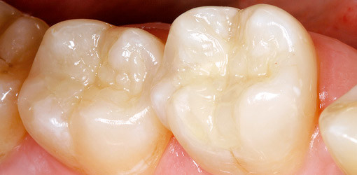 Seitenzahnrestauration mit Nanocomposite