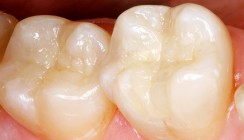 Seitenzahnrestauration mit Nanocomposite