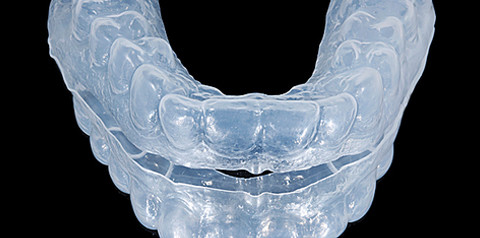 Keramikveneers – eine klinisch orientierte Übersicht