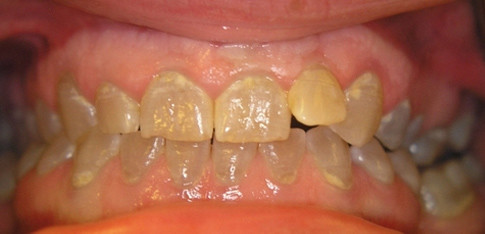 Dentinogenesis imperfecta hereditaria