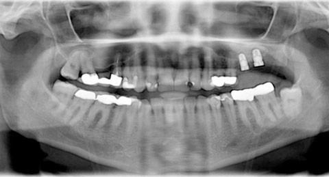 Mehr Sicherheit beim Sinuslift