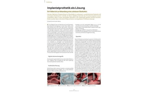 Implantatprothetik als Lösung - Ein Fallbericht zur Behandlung eines zahnlosen Oberkiefers