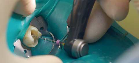 Eine sichere Methode zur Bestimmung der Arbeitslänge