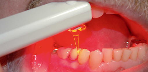 LED als alternative Behandlungsmethode?