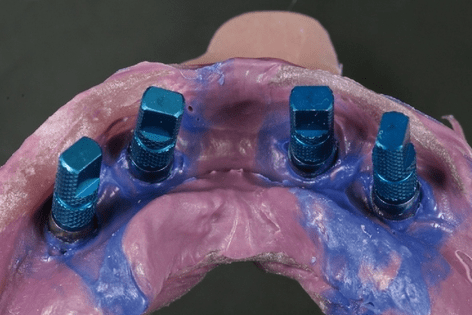 Die Behandlung zahnloser Kiefer – ein Fall für CAD/CAM