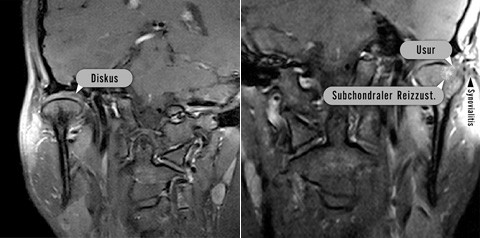 Die juvenile idiopathische Arthritis der Kiefergelenke