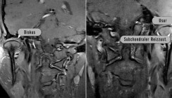 Die juvenile idiopathische Arthritis der Kiefergelenke