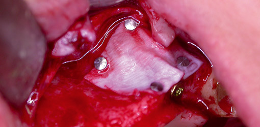 Ein individueller Ansatz zur zeitnahen Implantatversorgung