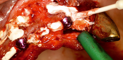 Augmentationen aus der Spritze