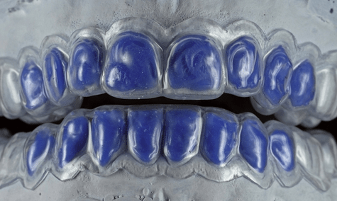 Stellenwert der Zahnaufhellung in der Ästhetik