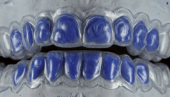 Stellenwert der Zahnaufhellung in der Ästhetik