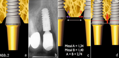 Über die Osseointegration hinaus