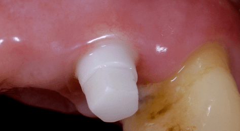 Vollkeramische Implantate – ein evidenzbasiertes Verfahren?