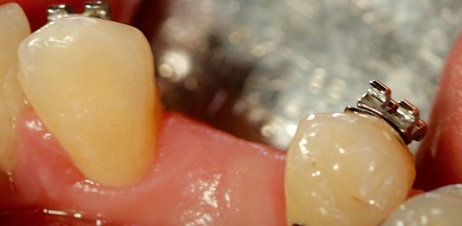 Die Optimierung des Implantatlagers
