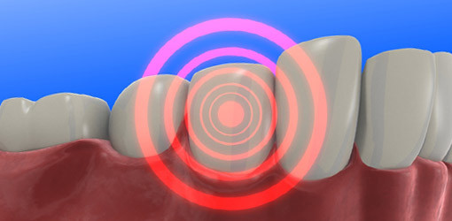 Karies keine Chance geben