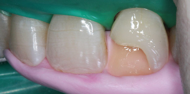 Ästhetisch anspruchsvollste Restaurationen