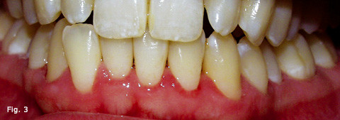 The Effectiveness of Conservative, Contemporary, Nonsurgical Periodontal Treatment
