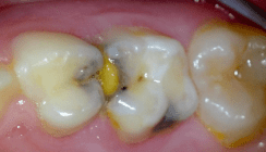 Prophylaxe von Anfang an