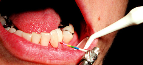 Individualprophylaxe leicht gemacht