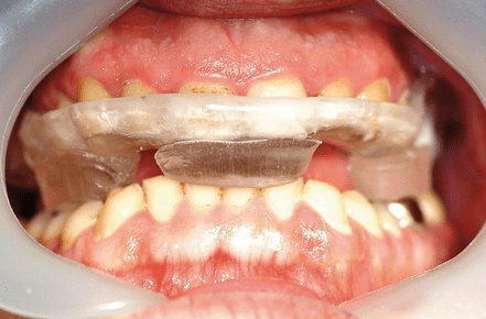 Sicherheit bei der Implantologie