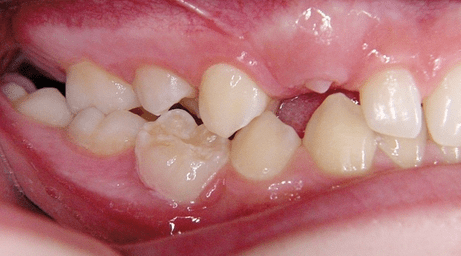 Okklusales CMD - Risikofaktoren im Wachstum