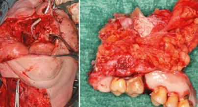 Der Risikopatient in der Implantologie: Radiatio