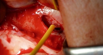 Die Sinusbodenelevation und ihre Risiken