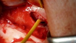 Die Sinusbodenelevation und ihre Risiken