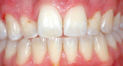 Möglichkeiten und Grenzen der ästhetischen Parodontalchirurgie