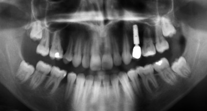 Parodontale Frühdiagnostik