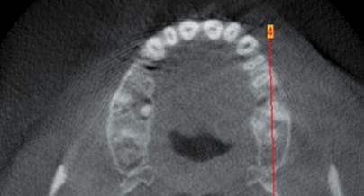Die Bedeutung des DVTs in der Parodontologie
