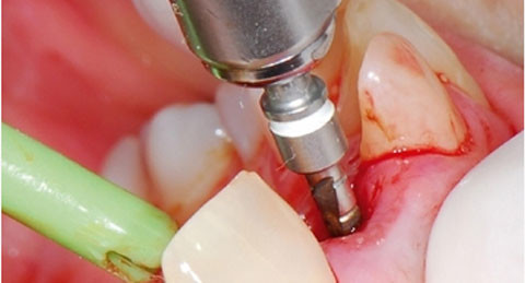 Sinnvoller Einsatz der Sofortimplantation