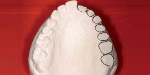 Die einzeitige Ausformung der periimplantären Weichgewebe