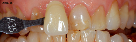 Frontzahnrestaurationen: Bleaching als Vorbehandlung