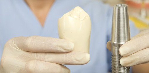 Implantatverlust: Das System und die Prothetik spielen eine Rolle