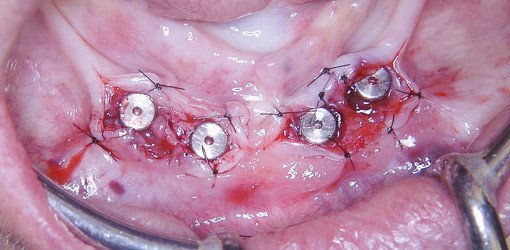 Chirurgie und Laser in Kombination