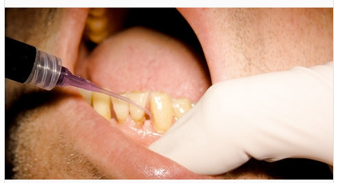 Der Laser als Multitalent – ein Update