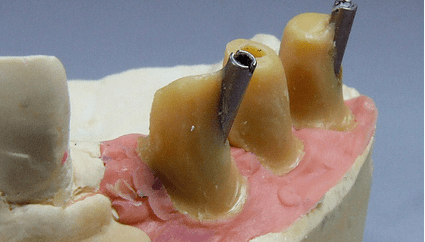 Prothetik mit individuellen Emergenzprofilen