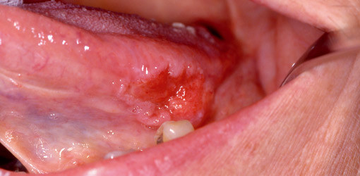 Möglichkeiten und Grenzen der Bürstenbiopsie