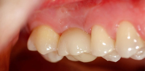 Individuelle Anpassung dank Vollkeramik