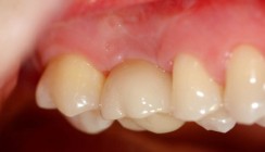 Individuelle Anpassung dank Vollkeramik