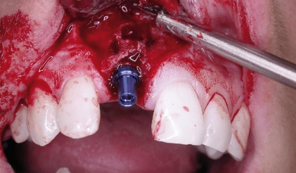 Der lange Weg zur Frontzahnästhetik