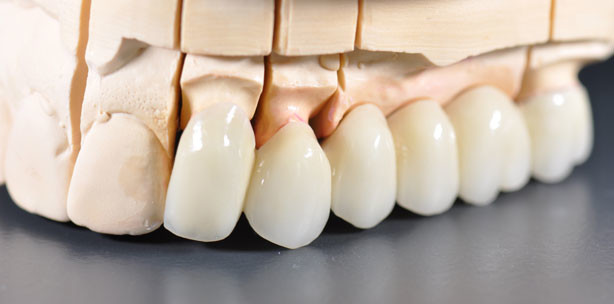 Keine neuen Zähne mehr über 80!