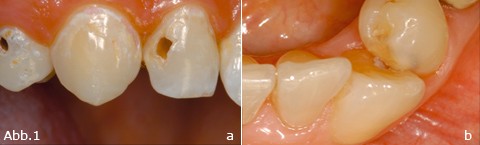 Die Abschätzung des Kariesrisikos
