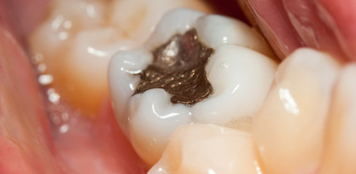 Kaum ein Gebiss ohne Makel