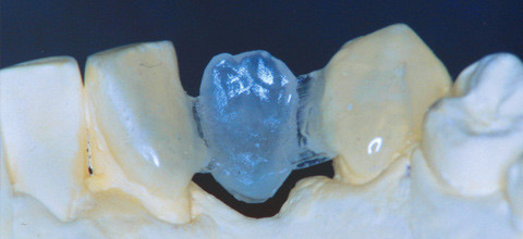 Behandlung mit einer faserverstärkten Klebebrücke